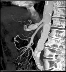 Celiac Artery Aneurysm - CTisus CT Scan