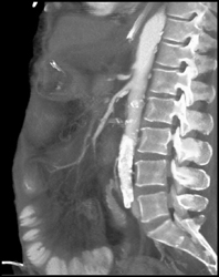 Stenosis of Origin of Celiac Artery - CTisus CT Scan