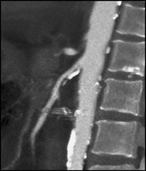 Diseased Celiac Artery and Plaque in SMA - CTisus CT Scan