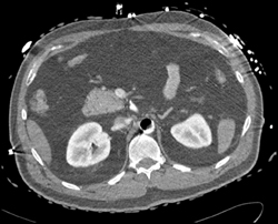 Air in Aorta Due to Aortic Balloon Pump (normal) - CTisus CT Scan