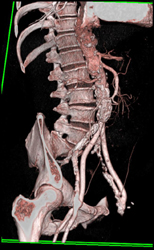 Aorto-bifemoral Grafts - CTisus CT Scan