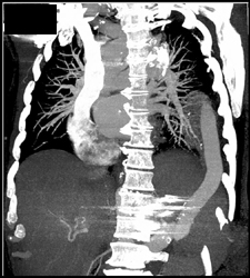 Unusual Graft From Heart to Abdominal Aorta - CTisus CT Scan