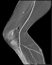 Abscess Behind Knee on CTA - CTisus CT Scan