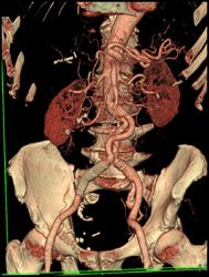 Aortic Aneurysm Repair - CTisus CT Scan