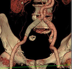 Endovascular Stents in External Iliac Artery - CTisus CT Scan