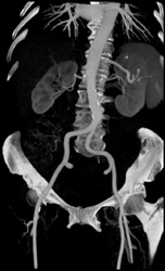 Atherosclerotic Disease With Focal Ulceration - CTisus CT Scan