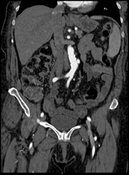 Focal Ulceration - CTisus CT Scan