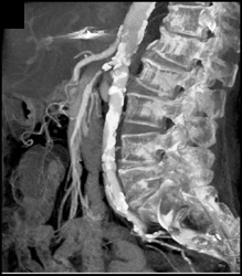 Diseased SMA - CTisus CT Scan