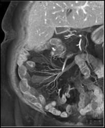 Normal Vessels to Ileum - CTisus CT Scan