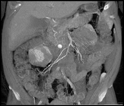 Pseudoaneurysm Or Bleed Actually Due to Pill (pseudolesion) - CTisus CT Scan