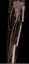 CTA Post Trauma - CTisus CT Scan