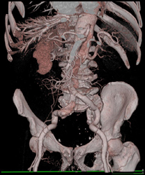 Aortic Dissection - CTisus CT Scan