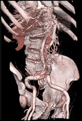 Aortic Dissection - CTisus CT Scan