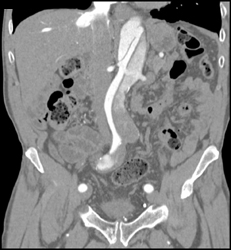 Aortic Dissection - CTisus CT Scan