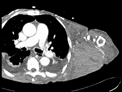 Hematoma Axilla - CTisus CT Scan