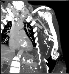 Av Shunts for Dialysis - CTisus CT Scan