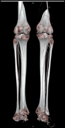 Normal CTA - CTisus CT Scan