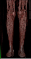 Normal CTA - CTisus CT Scan