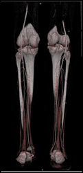 Normal CTA - CTisus CT Scan