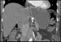 Celiac Artery Aneurysm - CTisus CT Scan