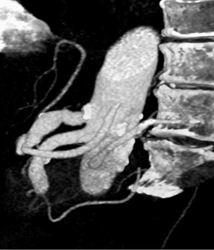 Celiac Artery Aneurysm - CTisus CT Scan