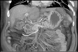 Normal Mesenteric Vessels - CTisus CT Scan