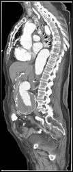 Abdominal Aortic Aneurysm (AAA) - CTisus CT Scan