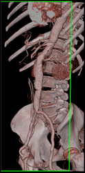 Abdominal Aortic Aneurysm (AAA) - CTisus CT Scan