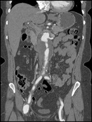 Abdominal Aortic Aneurysm (AAA) With Extensive Thrombus - CTisus CT Scan