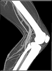 CTA Knee - CTisus CT Scan