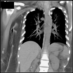 Broken Catheter in Pulmonary Artery - CTisus CT Scan