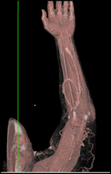 CTA in Patient With Arteriovenous (AV) Fistulae - CTisus CT Scan