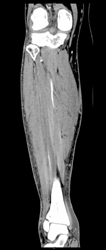 CTA Leg - CTisus CT Scan