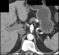 Celiac Artery Aneurysm - CTisus CT Scan