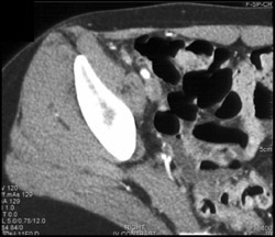 Occlusion of Right Femoral Artery - CTisus CT Scan