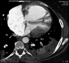 Pulmonary Embolism - CTisus CT Scan