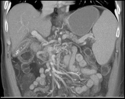 Extensive Varices - CTisus CT Scan