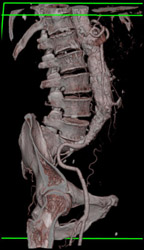 Aortic Aneurysm - CTisus CT Scan