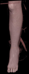 Ulcer on Leg - CTisus CT Scan