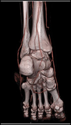 CTA of Leg - CTisus CT Scan