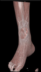 CTA With Av Shunting - CTisus CT Scan