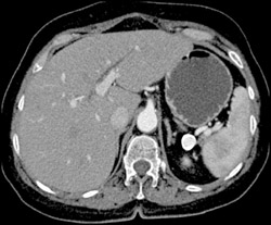 Splenic Artery Aneurysm - CTisus CT Scan