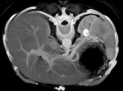 Splenic Artery Aneurysm - CTisus CT Scan