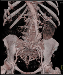 Aortic Dissection - CTisus CT Scan