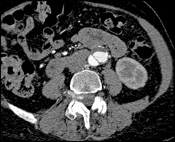 Aortic Dissection - CTisus CT Scan