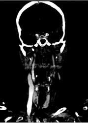 Stent in Carotid Artery - CTisus CT Scan