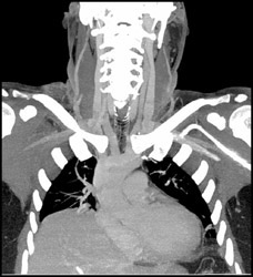 Clot in Right Jugular Vein - CTisus CT Scan