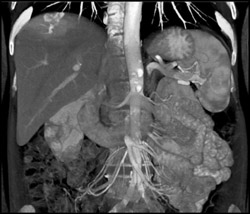 Arteriovenous Malformation (AVM) in Dome of Liver - CTisus CT Scan