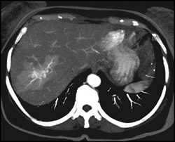 Arteriovenous Malformation (AVM) in Dome of Liver- Flow Changes Also Noted - CTisus CT Scan