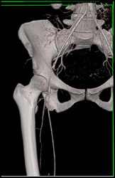 Occluded Right Femoral Artery - CTisus CT Scan